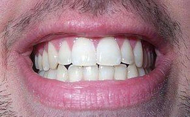 Seis malos hábitos que dañan los dientes