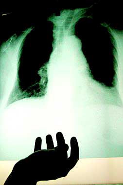 Un médico analiza la radiografía de un paciente con una enfermedad pulmonar./
