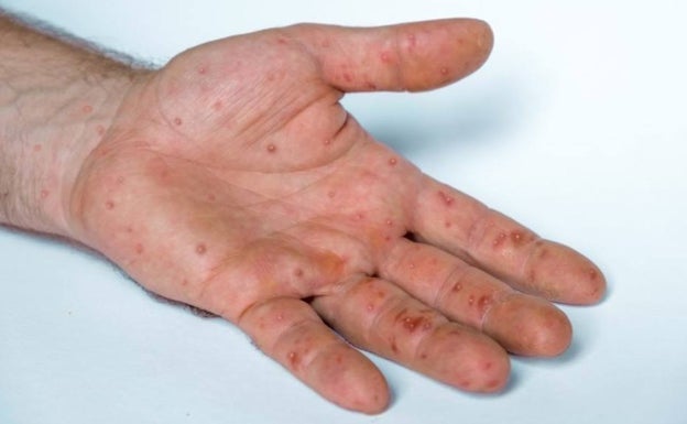 Las enfermeras piden más protección para evitar la infección por viruela del simio